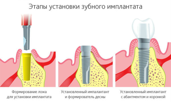 Імплантація зубів: види операцій, типи імплантів, показання та протипоказання