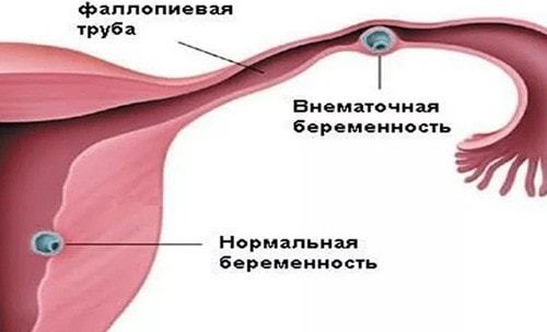 Чи можна завагітніти під час місячних: ознаки вагітності на ранніх термінах