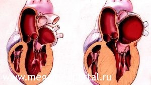 Серцевий горб у дітей і дорослих, його причини і лікування