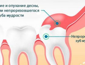 Опухла щока, але зуб не болить: причини запалення, як зняти пухлина, що робити з набряком всередині порожнини рота