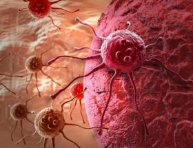 Гормонозалежний рак молочної залози: стадії розвитку, клінічні прояви, методи лікування і прогноз