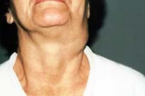 Доброякісні новоутворення на шкірі: родимки, невуси, папіломи, лімфангіоми, ліпоми, фіброми, бородавки та ін. - опис і ризики переродження.