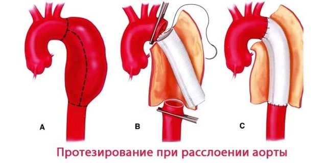 Аортит: що це таке, причини, симптоми, лікування, профілактика