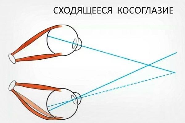 Косоокість у дітей: причини, симптоми, діагностика, лікування розходиться і сходиться косоокості