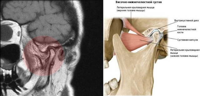 Як розшифрувати МРТ скронево-нижньощелепного суглоба? | ОкейДок