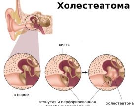 Холестеатома вуха: причини, симптоми і лікування