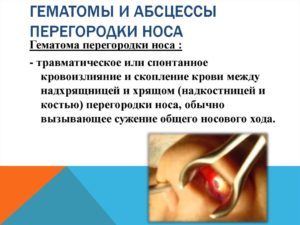 Абсцес і гематома перегородки носа: причини, симптоми і лікування захворювання