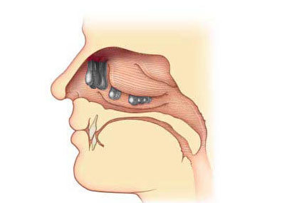 Поліпи в носі: як виглядають, симптоми і лікування у дорослих