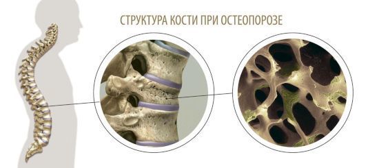 Денситометрія кісток: що це таке і як її проводять?