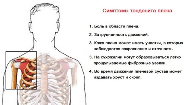 Болить плече при піднятті руки вгору: що робити, до якого лікаря йти