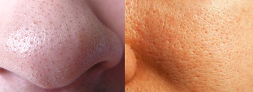 Розширені пори на обличчі: як позбутися в домашніх умовах, догляд за пористою шкірою