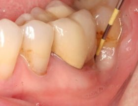 Кіста зуба: що це таке, причини появи, методи лікування з докладними фото
