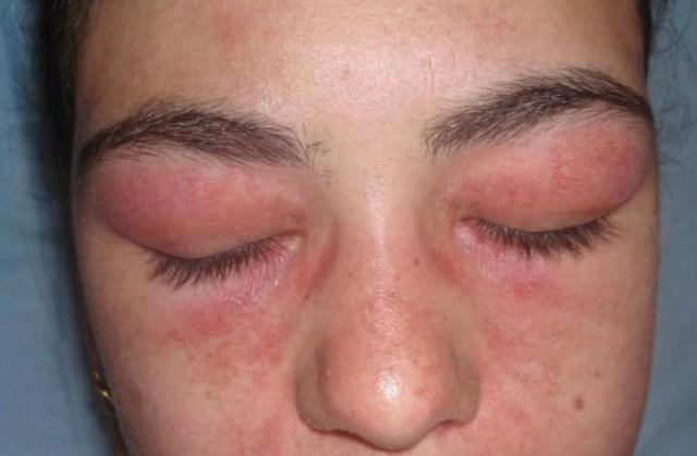 Алергія на нарощені вії: що робити, симптоми і лікування