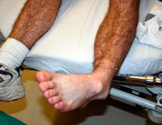 Вивих ноги в районі щиколотки: симптоми і лікування вивиху гомілковостопного суглоба