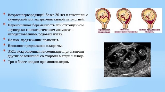 Передлежання плаценти при вагітності: що це, класифікація, фото, УЗД, пологи