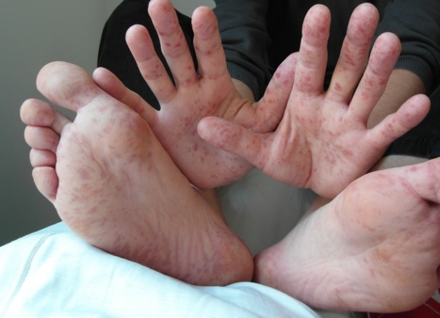 Синдром «рука-нога-рот»: симптоми, лікування, діагностика і причини захворювання 