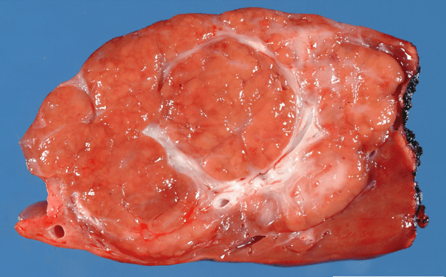 Нодулярна гіперплазія печінки: що це, симптоми і лікування, вогнищевий цироз на КТ і МРТ