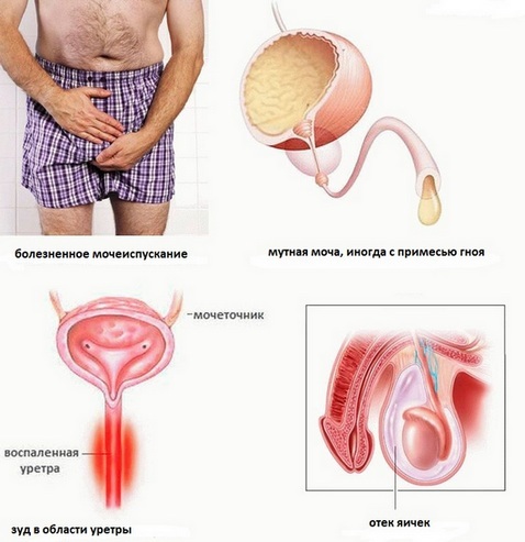 Хламідіоз у чоловіків: симптоми і лікування, препарати, наслідки, перші ознаки