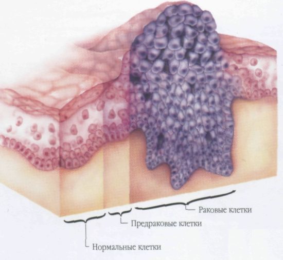 Рак статевого члена: стадії, симптоми, лікування і причини раку статевого члена
