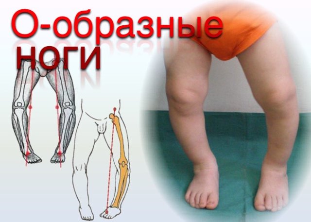 О-образні ноги, варусна деформація у дитини і дорослого: що носити, лікування
