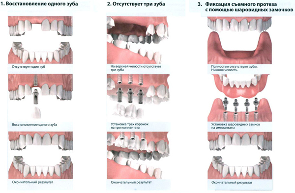 Імплантація зубів: види операцій, типи імплантів, показання та протипоказання