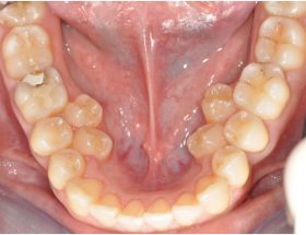 Гіпердонтія, поліодонтія, гіпердентія: причини аномалії числа зубів, методи лікування та можливі ускладнення