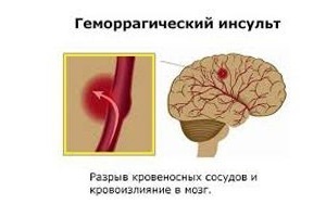 Геморагічний інсульт головного мозку: лікування, наслідки та прогнози