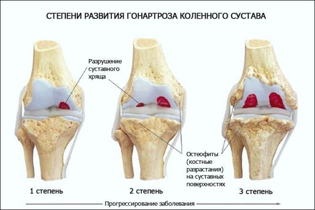 Посттравматичний артроз колінного суглоба: ступеня, симптоми, лікування