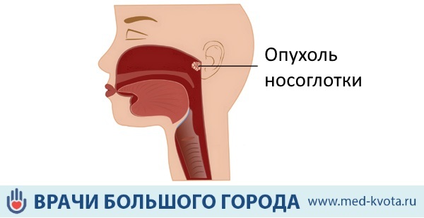 Пухлина носоглотки: симптоми і ознаки захворювання