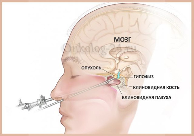 Пухлини гіпофіза - симптоми у жінок і чоловіків, діагностика, лікування.