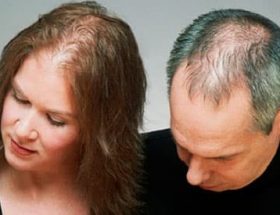 Чому випадає волосся у жінки в молодому віці: головні причини і методи усунення проблеми