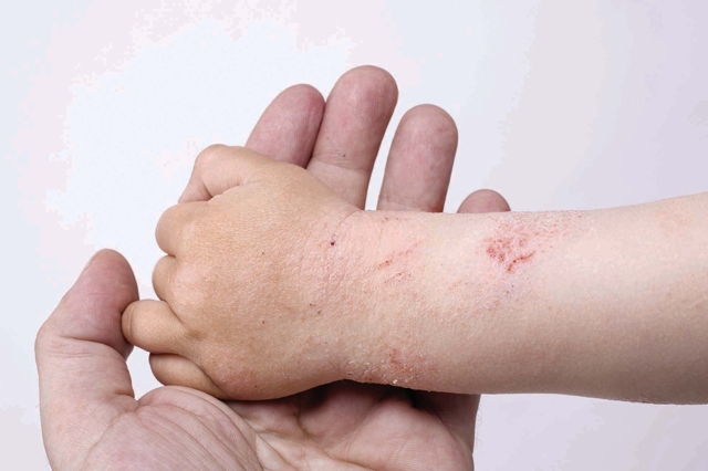 Ципко на руках - причини появи, способи лікування та профілактики | ОкейДок