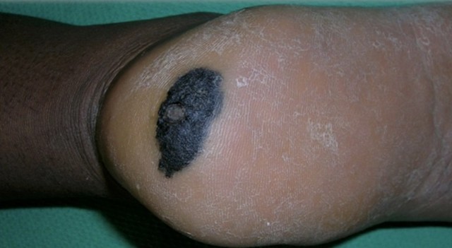 Видалення шіпіци на нозі у дитини: як видалити шіпіцу Саліпод - правила застосування пластиру 