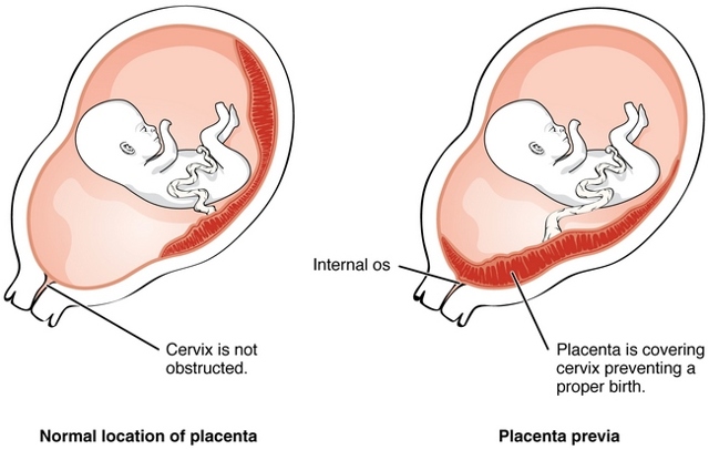 Низька плацентация при вагітності по передній, по задній стінці: що це значить з 20 тижня