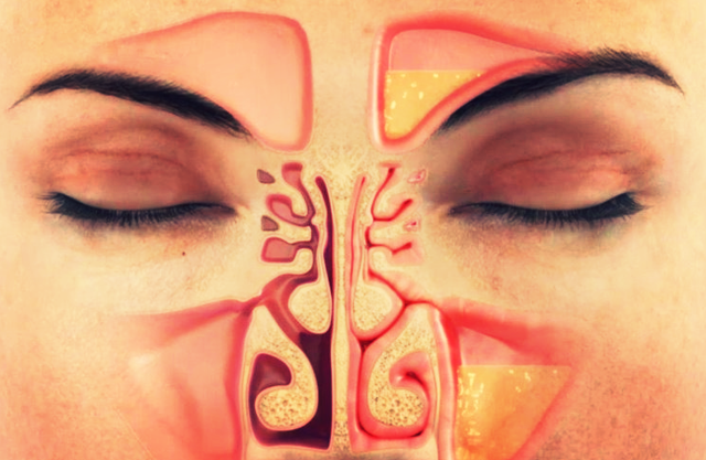 Запах з носа при гаймориті і нежиті: причини і лікування