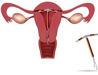 Внутрішньоматкова контрацепція, спіраль: плюси і мінуси, види ВМС