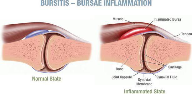 Бурсит - симптоми, причини розвитку, методи лікування бурситу - операція при бурситі, лікування бурситу народними засобами. 