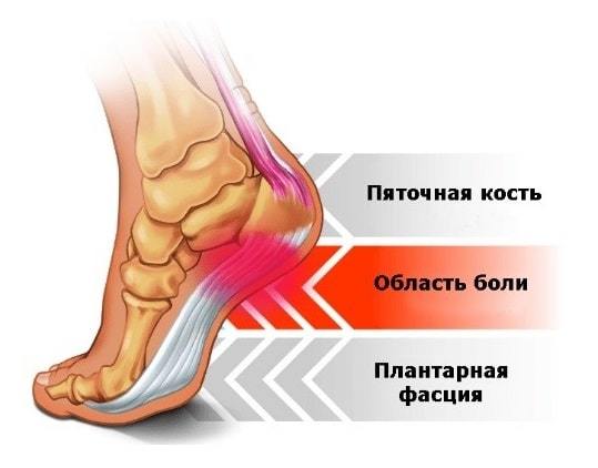 П'яткова шпора: симптоми і лікування в домашніх умовах, народні засоби лікування шпори