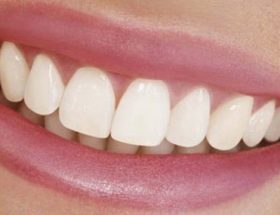 Переваги та недоліки виниров на зуби: фотографії до і після процедури