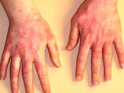 Актініческій дерматит на руках, на обличчі: що це таке і як проявляється, методи лікування та профілактики