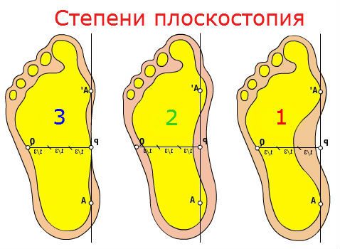 Порожня стопа: що це таке, симптоми і лікування, чи можлива служба в армії