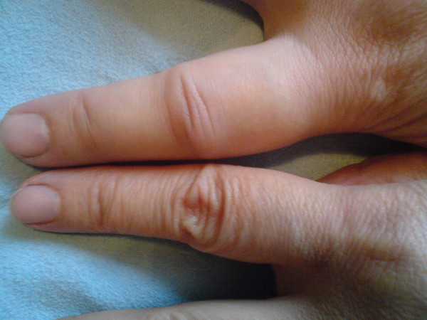 Вивих пальця на руці: що робити, симптоми вивиху великого пальця на руці, лікування
