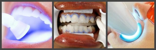 Хімічне відбілювання зубів: підготовка, наслідки, протипоказання,