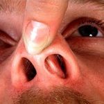 Перфорація носової перегородки: симптоми і лікування з операцією і без