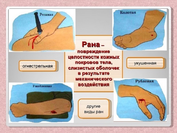 Лікування відкритих ран в домашніх умовах: чим обробити відкриту рану, етапи загоєння ран, мазі для ран