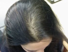 Випадання волосся у жінок в різні пори року: чому взимку, восени і навесні починається линька
