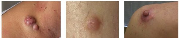 Вибухає дерматофібросаркома шкіри: причини, симптоми, лікування, прогноз, виживаність