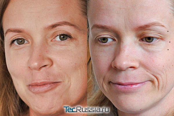 Ботокс для особи: фото до і після, протипоказання для уколів краси, побічний ефект
