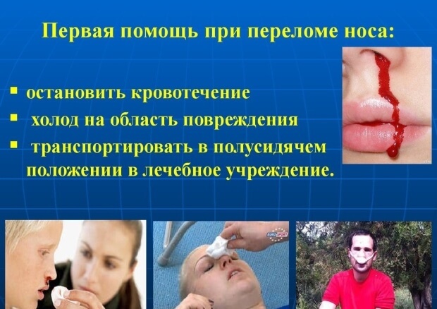 Перелом кісток носа: симптоми, ступеня тяжкості перелому носа, наслідки