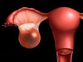 Сперматоцеле: лікування кісти придатка яєчка у чоловіків, операція при сперматоцеле